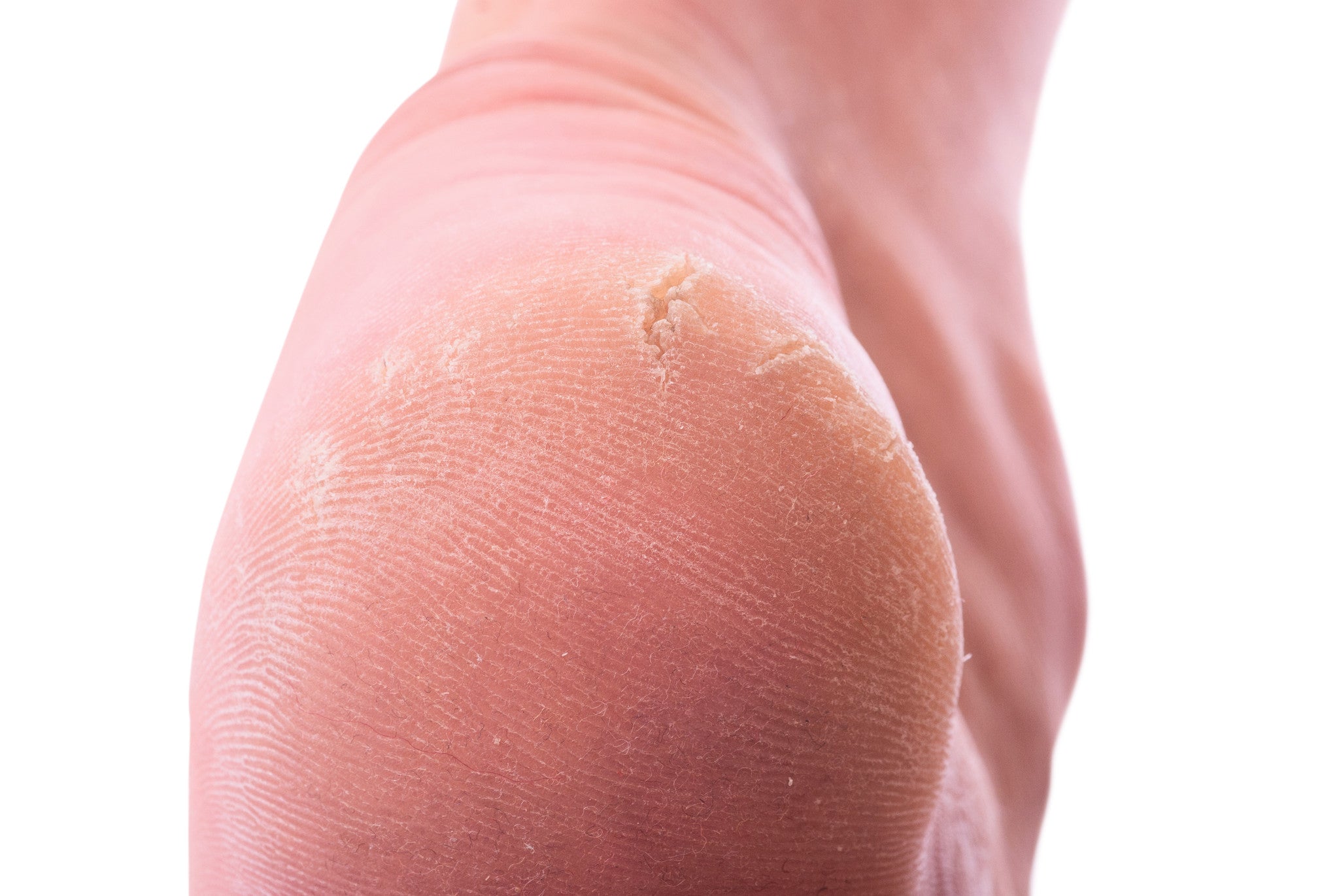 What’s the Difference Between Corns and Calluses?