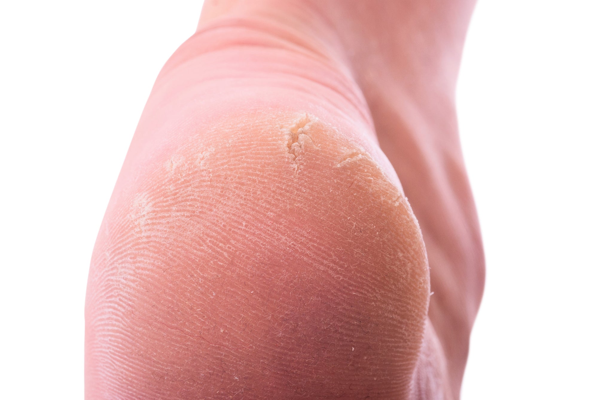 What’s the Difference Between Corns and Calluses? OrthoFeet