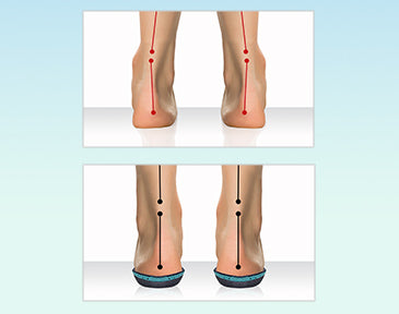 Flat Feet Overpronation Causes, Treatment and Prevention