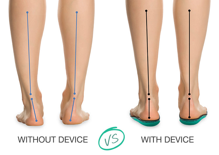 Supination of foot shoes Clearance